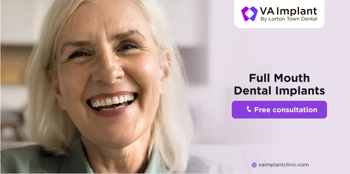 All-on-Four Implants and dental implants