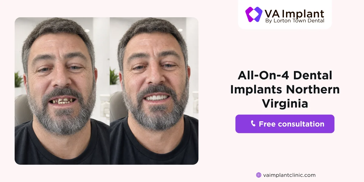 all on 4 dental implants in northern virginia